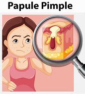 Image result for Pimple Cartoon