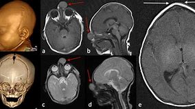 Image result for Gliomas of Nasal Cavity