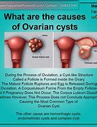Image result for 8 Cm Ovarian Cyst