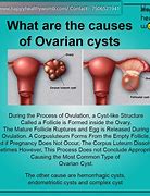 Image result for 13 Cm Ovarian Cyst