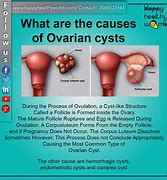 Image result for 10 Cm Ovarian Cyst