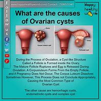 Image result for 8 Cm Cyst On Ovary