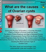 Image result for Cyst in Ovaries