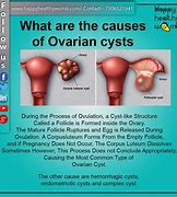 Image result for Small Ovarian Cyst