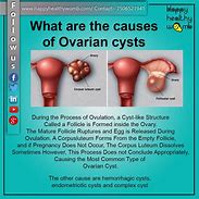 Image result for Complex Cyst On Ovary
