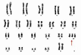 Image result for Trisomy 18 Characteristics