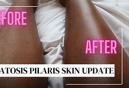 Image result for Keratosis Pilaris On Dark Skin