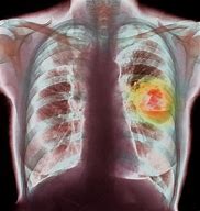 Image result for Lung Tumor Size