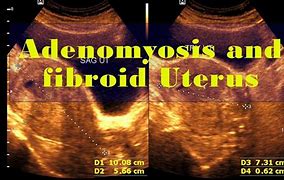 Image result for 11 Cm Fibroid
