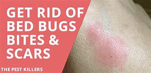 Image result for Bed Bug Bite Scars