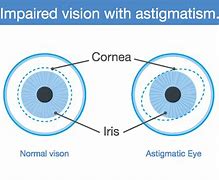 Image result for Blurry Vision with Contacts Astigmatism
