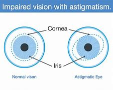 Image result for Astigmatism Eye Headlight
