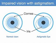 Image result for Pictures of Astigmatism Vision