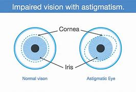 Image result for Astigmatism Eye Real Pics