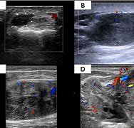 Image result for Soft Tissue Sarcoma Leg