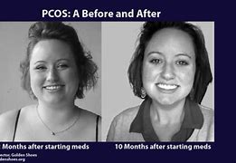 Image result for Polycystic Ovary Syndrome Weight Gain
