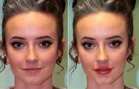 Image result for Silicone Lip Injections