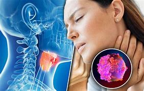 Image result for HPV and Throat Cancer