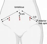 Image result for Paracentesis Puncture Site