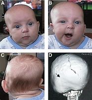 Image result for Posterior Plagiocephaly