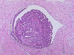 Image result for Ductal Papilloma