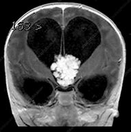 Image result for Choroid Plexus Papilloma MRI