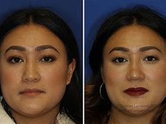 Image result for Rhinoplasty for Wide Nose