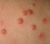 Image result for Molluscum Contagiosum On Baby