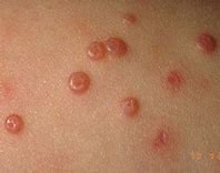 Image result for Molluscum Contagiosum African American