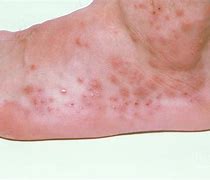 Image result for What Do Bed Bug Bites Look Like Photo On Foot