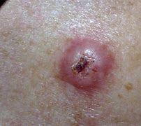 Image result for Squamous Cell Skin Cancer Lip