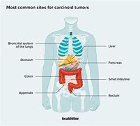Image result for Screening for Carcinoid Tumor