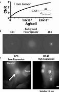 Image result for How Big Is 5 mm Tumor