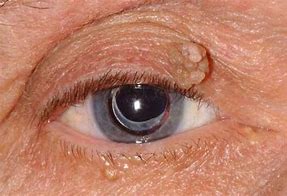 Image result for HPV On Eyelid