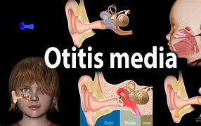 Image result for ofitis