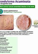 Image result for Extensive Condyloma