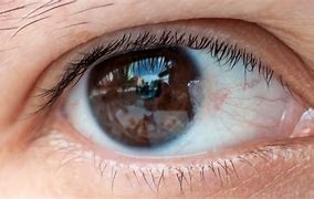 Image result for Conjunctival Papilloma Pterygium