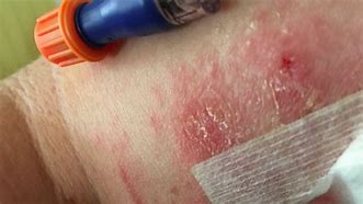 Image result for PICC Line Infection