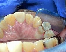 Image result for Broken Rotten Teeth