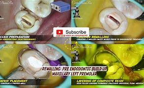 Image result for Unicore Dental Composite Image