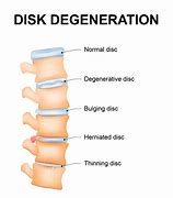 Image result for Spinal Disc Degeneration