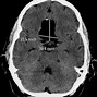 Image result for Dermoid Cyst Brain