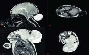 Image result for Occipital Meningocele