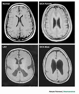 Image result for Lissencephaly CT