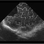 Image result for Porencephalic Cyst Ultrasound