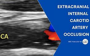 Image result for Carotid Artery Occlusion Ultrasound