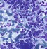 Image result for Round Cell Sarcoma