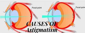 Image result for Causes of Astigmatism