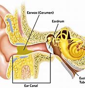 Image result for Impacted Ear Wax