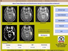 Image result for Brain Cancer Cells